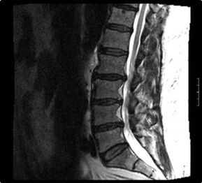 röntgenfoto van de cervicale wervelkolom met osteochondrose