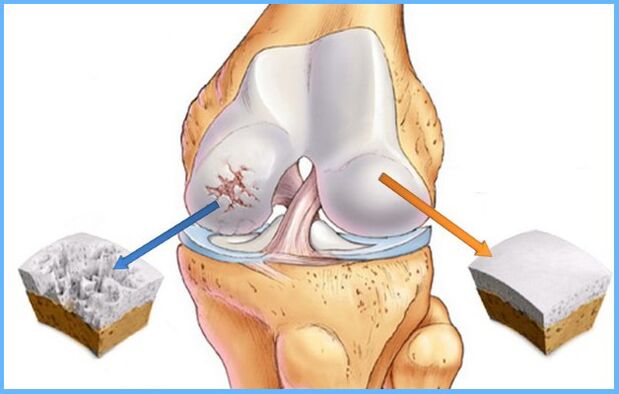 Arthrose van het kniegewricht