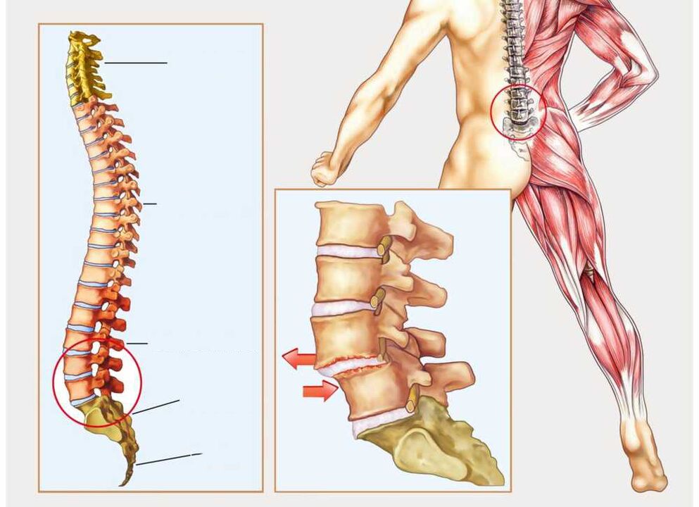 gezonde en zieke wervelkolom