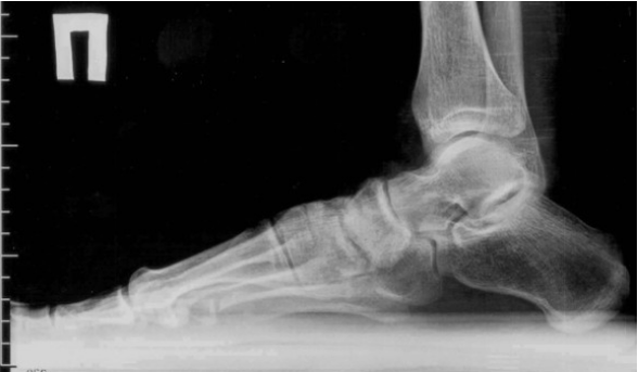 Arthrose van de tenen en voeten