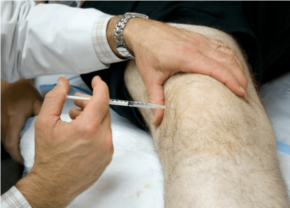 Intra -articulaire toediening van analgetica bij ernstige pijn